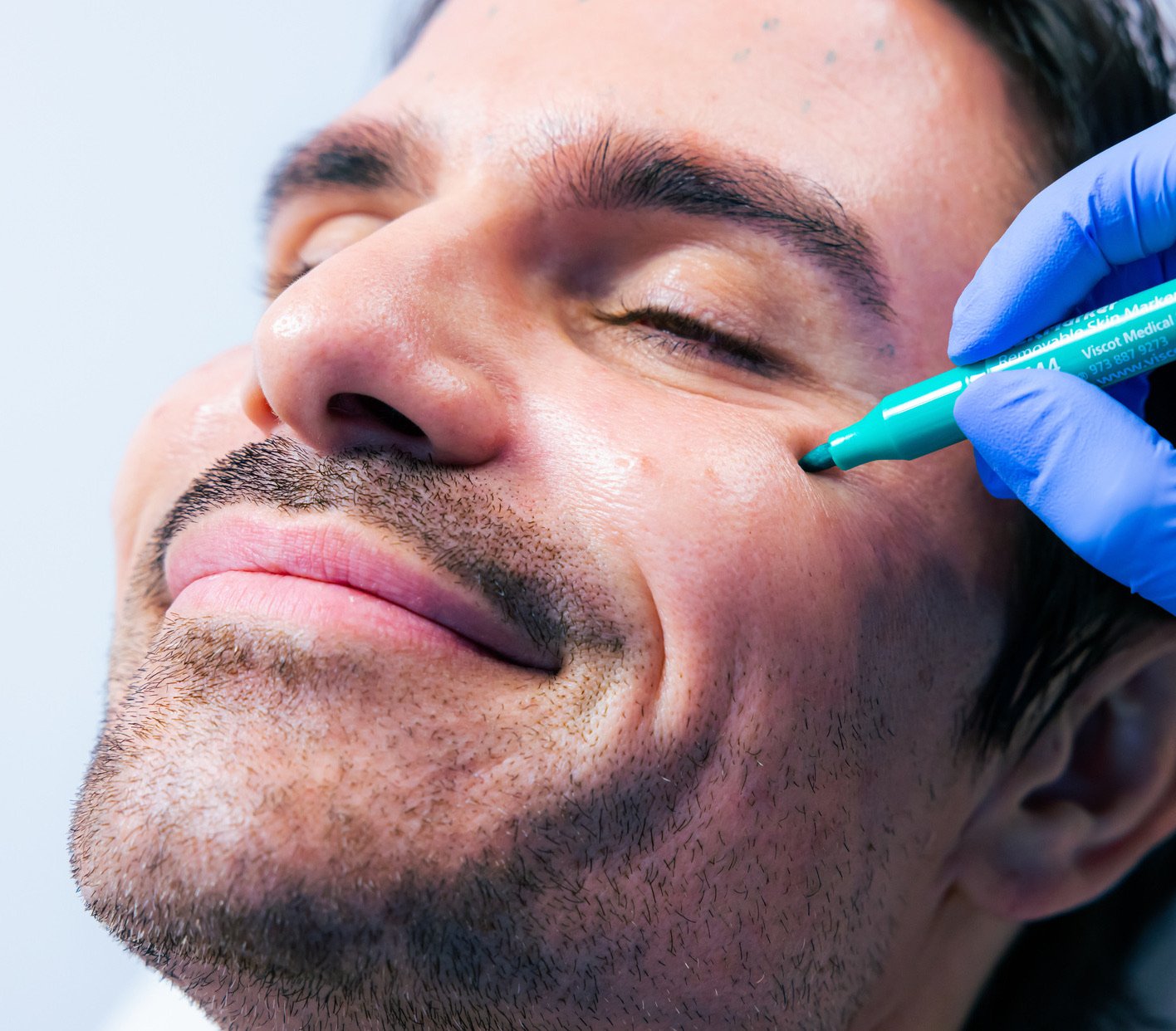 Blue gloved hand uses a blue skin marker on man's face during treatment preparation.